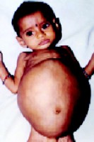 /album/enfermedades-extra%c3%b1as/fetus-jpg/